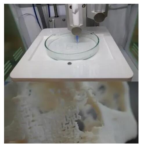 磷酸三钙（TCP）：3D打印骨骼植入物的新宠儿 