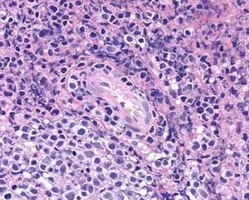 NK-92人恶性非霍奇金淋巴瘤患者的自然杀伤细胞