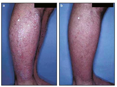 Figure. 1. Patient treated with clobetasol propionates pray at base line(a) and at week4 (b).png