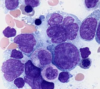人弥漫性大B细胞淋巴瘤细胞
